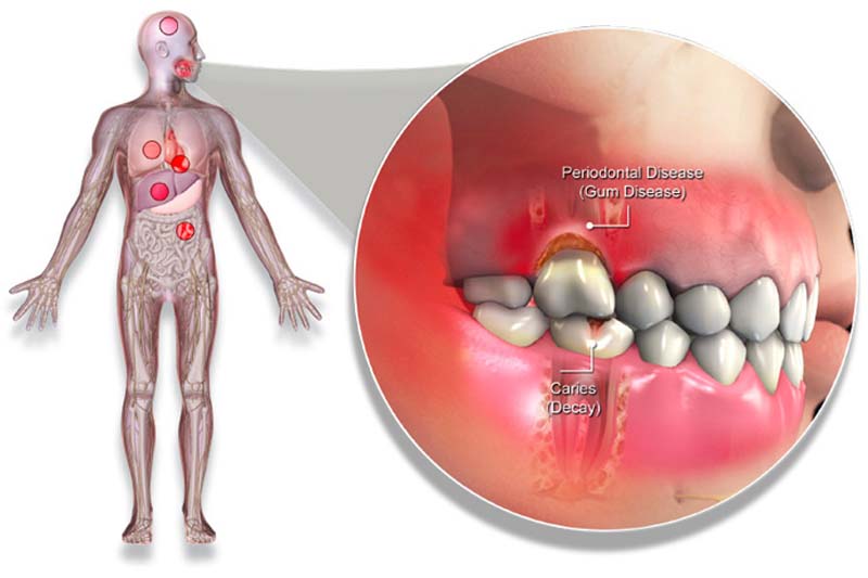 Gum Disease Gatineau