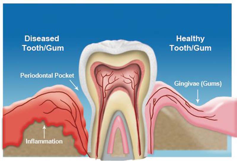 Gum Disease Ottawa
