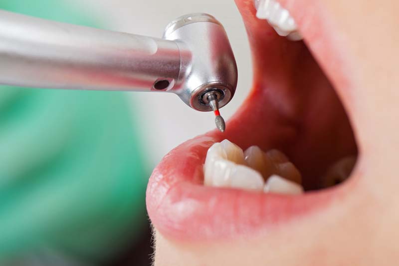 Endodontics Ottawa