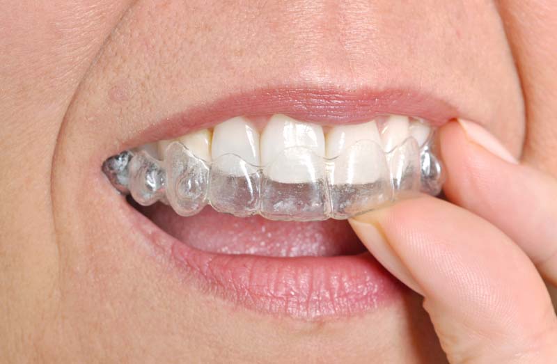 Invisalign Treatment Gatineau