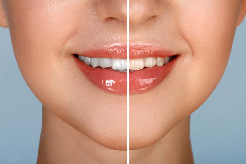 Teeth Whitening Ottawa