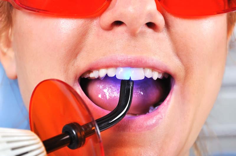 Dental Fillings Ottawa
