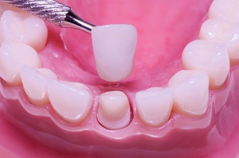 Dental Crown Bridge Ottawa