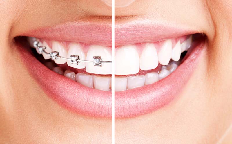 Orthodontist Ottawa