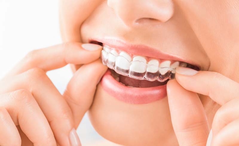 Invisalign Treatment Ottawa